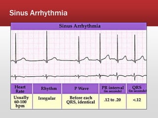 Sinus Arrhythmia
 