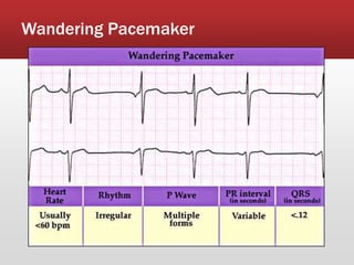 Wandering Pacemaker
 