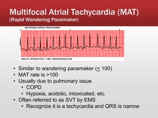 Multifocal Atrial Tachycardia (MAT)
(Rapid Wandering Pacemaker)
• Similar to wandering pacemaker (< 100)
• MAT rate is >100
• Usually due to pulmonary issue
• COPD
• Hypoxia, acidotic, intoxicated, etc.
• Often referred to as SVT by EMS
• Recognize it is a tachycardia and QRS is narrow
 