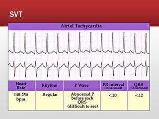 SVT
 