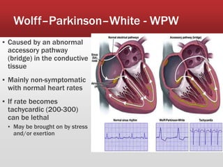 Wolff–Parkinson–White - WPW
▪ Caused by an abnormal
accessory pathway
(bridge) in the conductive
tissue
▪ Mainly non-symptomatic
with normal heart rates
▪ If rate becomes
tachycardic (200-300)
can be lethal
▪ May be brought on by stress
and/or exertion
 