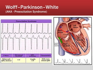 Wolff–Parkinson–White
(AKA - Preexcitation Syndrome)
 