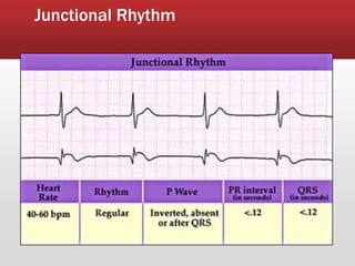 Junctional Rhythm
 