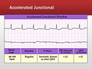 Accelerated Junctional
 