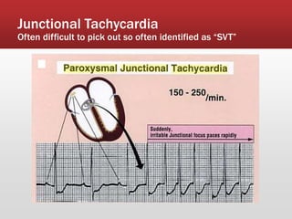 Junctional Tachycardia
Often difficult to pick out so often identified as “SVT”
 