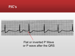 PJC’s
Flat or inverted P Wave
or P wave after the QRS
 