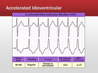 Accelerated Idioventricular
 