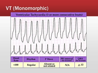 VT (Monomorphic)
 