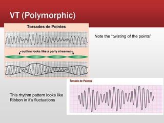 VT (Polymorphic)
Note the “twisting of the points”
This rhythm pattern looks like
Ribbon in it’s fluctuations
 