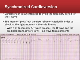 Synchronized Cardioversion
▪ Cardioversion is synchronized to avoid the refractory period of
the T wave
▪ The monitor “plots” out the next refractory period in order to
shock at the right moment – the safe R wave
▪ With a QRS complex & T wave present, the R wave can be
predicted (cannot work in VF – no wave forms present)
 