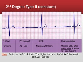 2nd Degree Type II (constant)
P Wave PR Interval QRS Characteristics
Uniform .12 - .20 Narrow & Uniform Missing QRS after
every other P wave
(2:1 conduction)
Note: Ratio can be 3:1, 4:1, etc. The higher the ratio, the “sicker” the heart.
(Ratio is P:QRS)
 