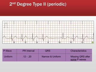 2nd Degree Type II (periodic)
P Wave PR Interval QRS Characteristics
Uniform .12 - .20 Narrow & Uniform Missing QRS after
some P waves
 