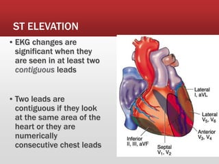 ST ELEVATION
▪ EKG changes are
significant when they
are seen in at least two
contiguous leads
▪ Two leads are
contiguous if they look
at the same area of the
heart or they are
numerically
consecutive chest leads
 