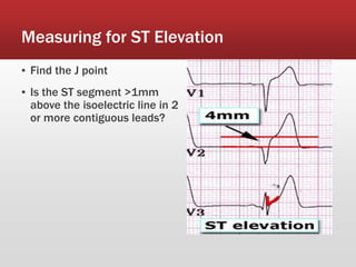 Measuring for ST Elevation
▪ Find the J point
▪ Is the ST segment >1mm
above the isoelectric line in 2
or more contiguous leads?
 