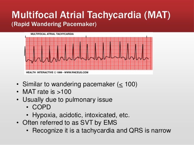 wandering atrial pacemaker vs mat