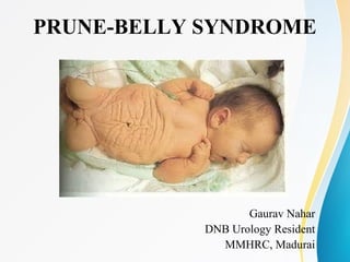 PRUNE-BELLY SYNDROME
Gaurav Nahar
DNB Urology Resident
MMHRC, Madurai
 
