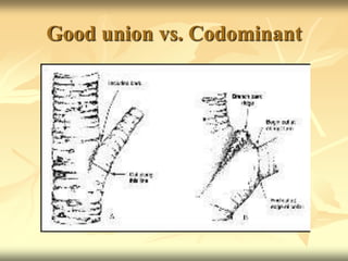 Good union vs. Codominant
 