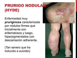 PRURIGO NODULAR
(HYDE)
Enfermedad muy
pruriginosa caracterizada
por nódulos firmes que
inicialmente son
eritematosos y luego,
hiperpigmentados con
descamación adherente.
(Tan severo que ha
inducido a suicidio)