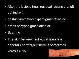• After the lesions heal, residual lesions are left
behind with
• post-inflammation hyperpigmentation or
• areas of hypopigmentation or
• Scarring
• The skin between individual lesions is
generally normal,but there is sometimes
xerosis cutis
 