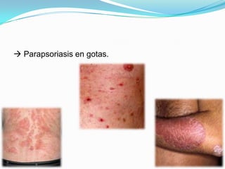  Parapsoriasis en gotas.
 