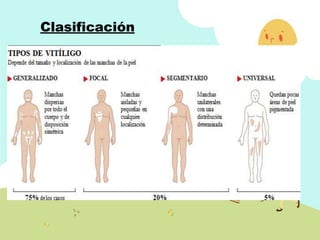 Clasificación
 