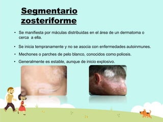 Segmentario
zosteriforme
• Se manifiesta por máculas distribuidas en el área de un dermatoma o
cerca a ella.
• Se inicia tempranamente y no se asocia con enfermedades autoinmunes.
• Mechones o parches de pelo blanco, conocidos como poliosis.
• Generalmente es estable, aunque de inicio explosivo.
 