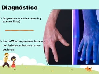 Diagnóstico
 Diagnóstico es clínico (historia y
examen físico)
 Luz de Wood en personas blancas o
con lesiones ubicadas en áreas
cubiertas
 