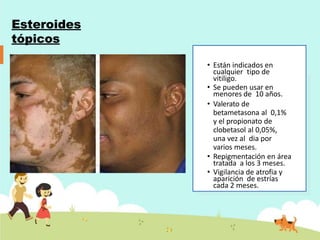 Esteroides
tópicos
• Están indicados en
cualquier tipo de
vitiligo.
• Se pueden usar en
menores de 10 años.
• Valerato de
betametasona al 0,1%
y el propionato de
clobetasol al 0,05%,
una vez al dia por
varios meses.
• Repigmentación en área
tratada a los 3 meses.
• Vigilancia de atrofia y
aparición de estrías
cada 2 meses.
 