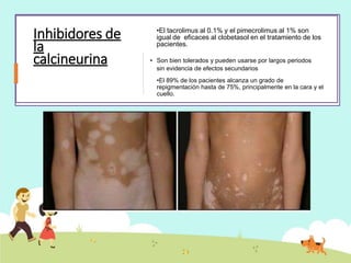 Inhibidores de
la
calcineurina
•El tacrolimus al 0.1% y el pimecrolimus al 1% son
igual de eficaces al clobetasol en el tratamiento de los
pacientes.
• Son bien tolerados y pueden usarse por largos periodos
sin evidencia de efectos secundarios
•El 89% de los pacientes alcanza un grado de
repigmentación hasta de 75%, principalmente en la cara y el
cuello.
 