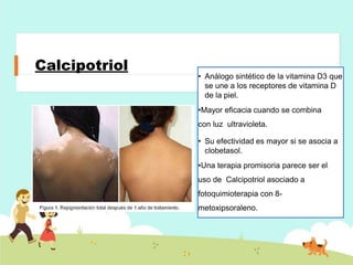Calcipotriol
• Análogo sintético de la vitamina D3 que
se une a los receptores de vitamina D
de la piel.
•Mayor eficacia cuando se combina
con luz ultravioleta.
• Su efectividad es mayor si se asocia a
clobetasol.
•Una terapia promisoria parece ser el
uso de Calcipotriol asociado a
fotoquimioterapia con 8-
metoxipsoraleno.
 
