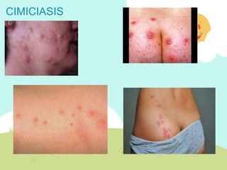 CIMICIASIS
 