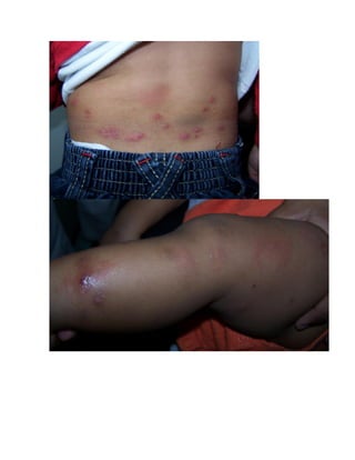 ¿Qué es el prúrigo por insectos?