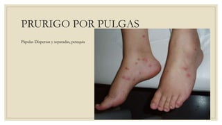 PRURIGO POR PULGAS
Pápulas Dispersas y separadas, petequia