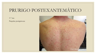 PRURIGO POSTEXANTEMÁTICO
5-7 sias
Paupulas prurignisosas