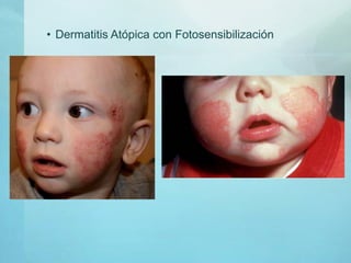 • Dermatitis Atópica con Fotosensibilización
 