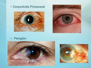 • Conjuntivitis Primaveral:
• Pterigión:
 