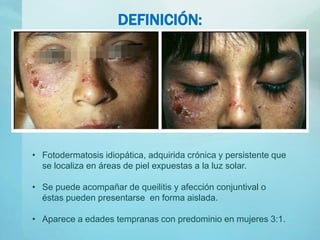 DEFINICIÓN:
• Fotodermatosis idiopática, adquirida crónica y persistente que
se localiza en áreas de piel expuestas a la luz solar.
• Se puede acompañar de queilitis y afección conjuntival o
éstas pueden presentarse en forma aislada.
• Aparece a edades tempranas con predominio en mujeres 3:1.
 