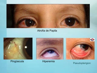 Pingüecula Hiperemia
Atrofia de Papila
Pseudopterigion
 