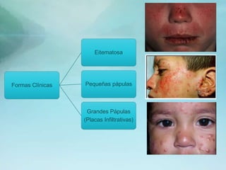 Formas Clínicas
Eitematosa
Pequeñas pápulas
Grandes Pápulas
(Placas Infiltrativas)
 