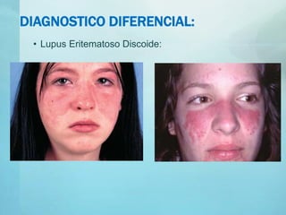 DIAGNOSTICO DIFERENCIAL:
• Lupus Eritematoso Discoide:
 