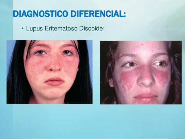 PRURIGO ACTINICO TRATAMIENTO EBOOK PRURIGO ACTINICO TRATAMIENTO EBOOK