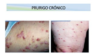PRURIGO CRÓNICO
 