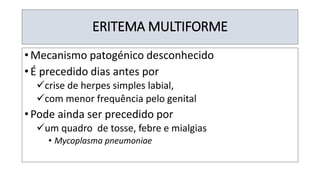 ERITEMA MULTIFORME
• Mecanismo patogénico desconhecido
• É precedido dias antes por
✓crise de herpes simples labial,
✓com menor frequência pelo genital
• Pode ainda ser precedido por
✓um quadro de tosse, febre e mialgias
• Mycoplasma pneumoniae
 