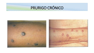 PRURIGO CRÓNICO
 