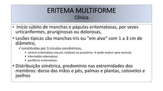 ERITEMA MULTIFORME
Clinica
• Início súbito de manchas e pápulas eritematosas, por vezes
urticariformes, pruriginosas ou dolorosas,
• Lesões típicas são manchas-iris ou ‟em alvo″ com 1 a 3 cm de
diâmetro,
✓constituídas por 3 círculos concêntricos,
▪ central eritematoso escuro, violáceo ou purpúrico → pode evoluir para vesícula
▪ intermédio edematoso
▪ periférico eritematoso
• Distribuição simétrica, predomínio nas extremidades dos
membros: dorso das mãos e pés, palmas e plantas, cotovelos e
joelhos
 