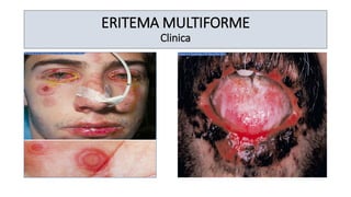 ERITEMA MULTIFORME
Clinica
 