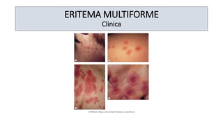 ERITEMA MULTIFORME
Clinica
 