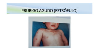 PRURIGO AGUDO (ESTRÓFULO)
 
