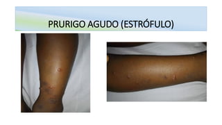 PRURIGO AGUDO (ESTRÓFULO)
 