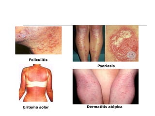 Foliculitis Eritema solar Psoriasis Dermatitis atópica 